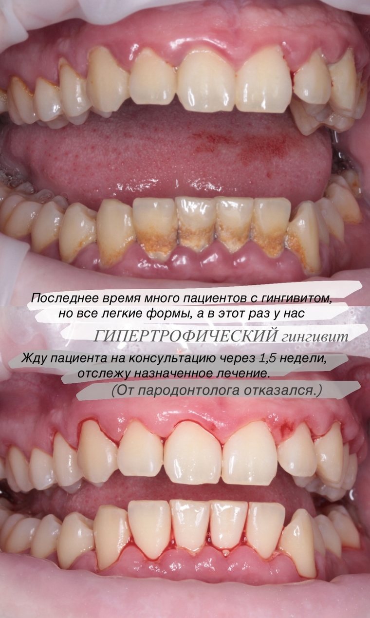 Гипертрофический гингивит: до и после